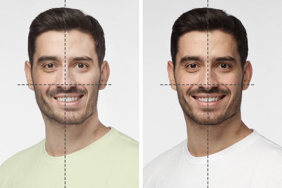 Cirugía Paralisis facial Guadalajara, Zapopan