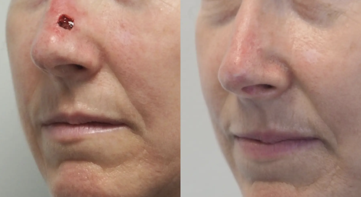 Cirugía para cáncer de piel en Guadalajara, con reconstruccion facial
