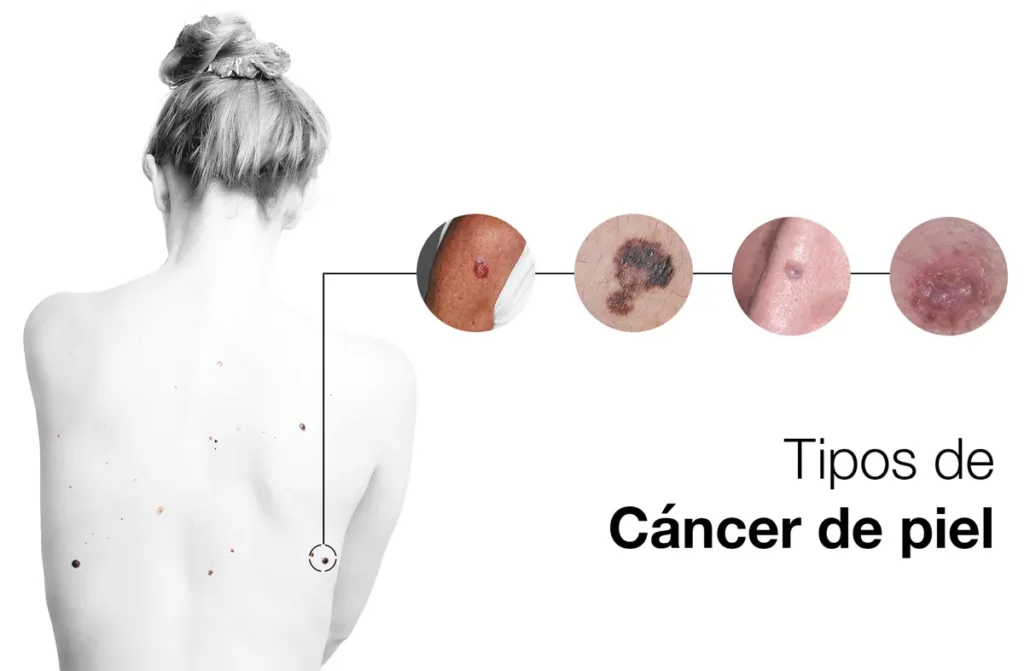 Cáncer de piel cirugía en Guadalajara