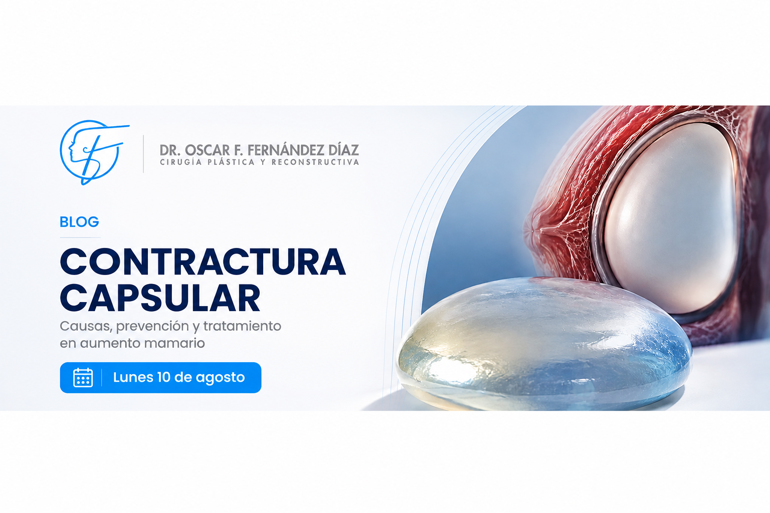 Contractura capsular: qué es, por qué ocurre y cómo prevenirla