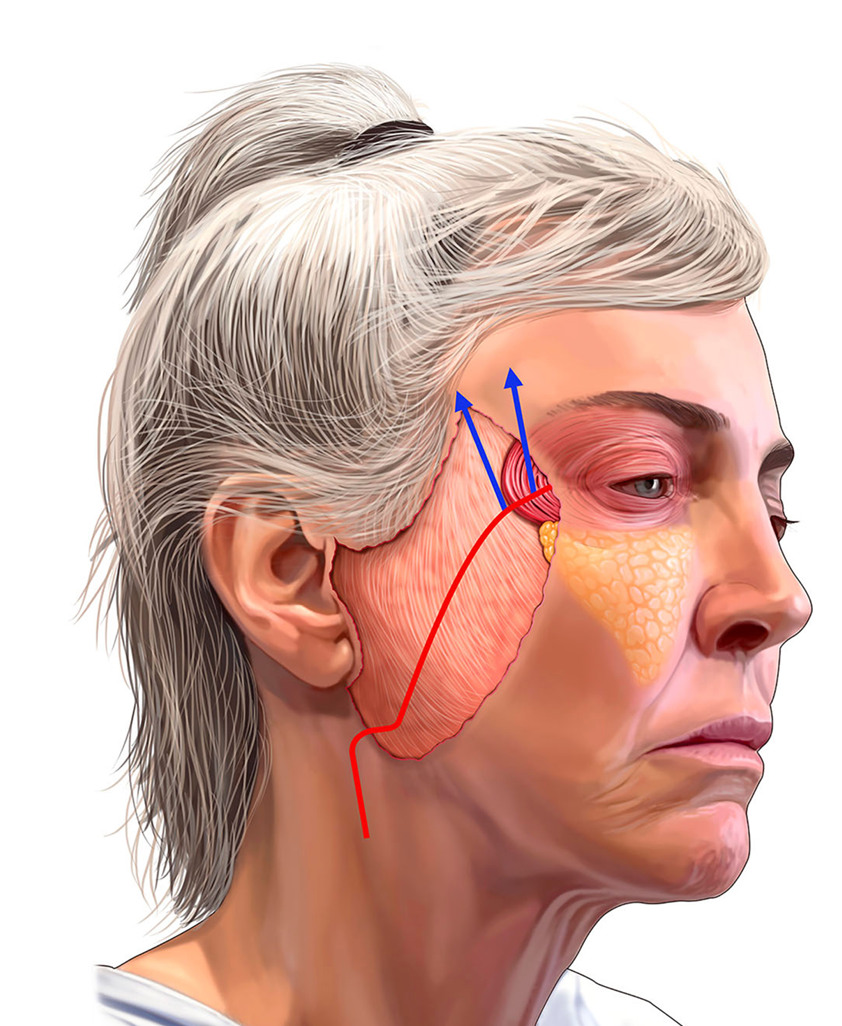 Vector de elevación monobloc en el facelift de plano profundo (Ackerman y Savalia, Aesthetic Plast Surg 2025, CC BY 4.0)
